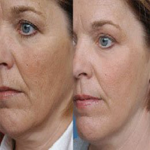 13 Best Microdermabrasion Scrubs, As Per An Expert – 2025 - Foto 7